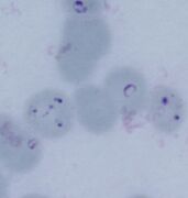 Multiply parasitised erythrocytes